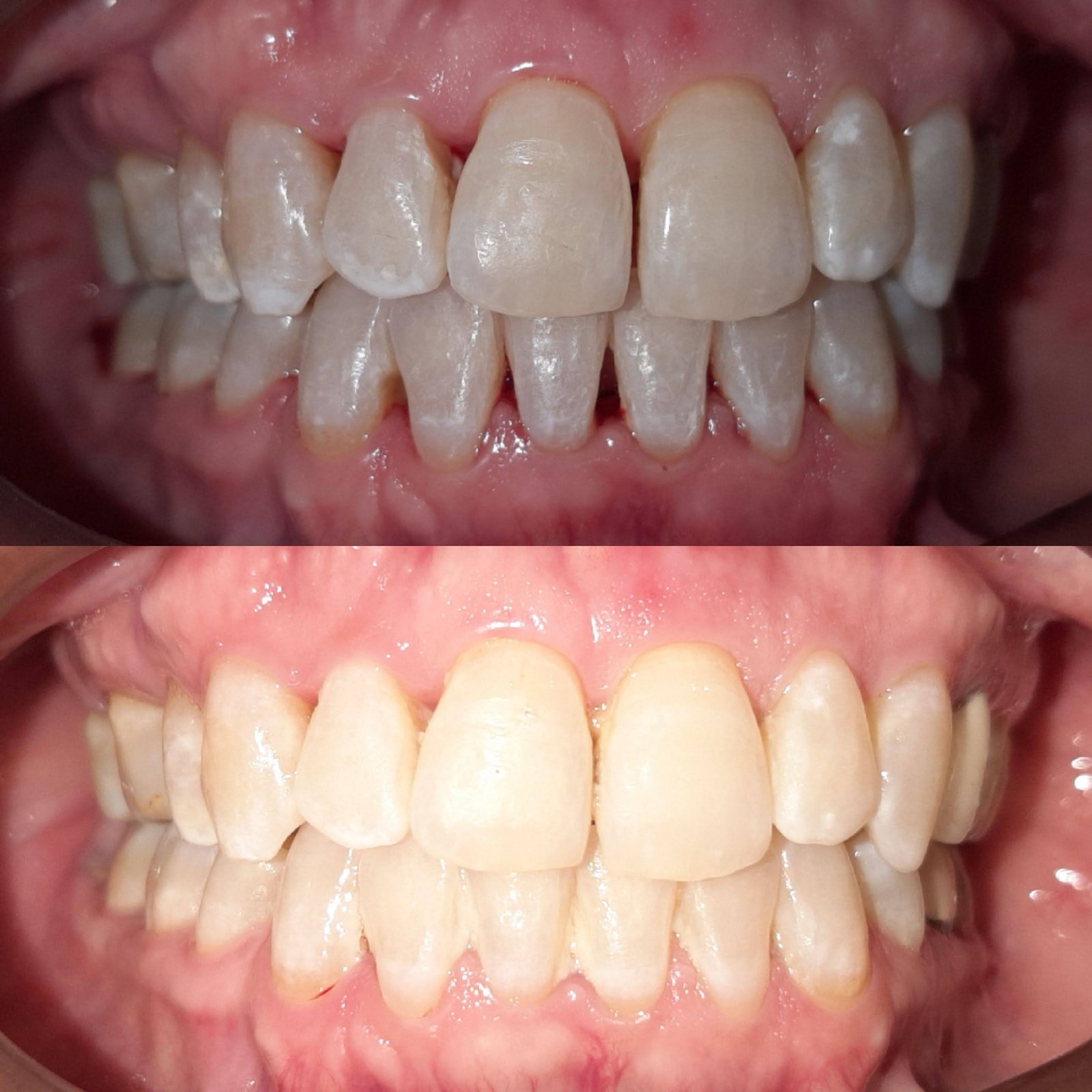 Limpieza dental
